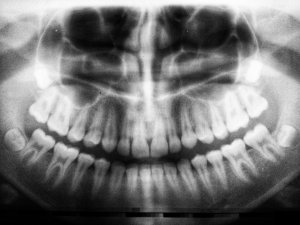 An x-ray of a full set of human teeth