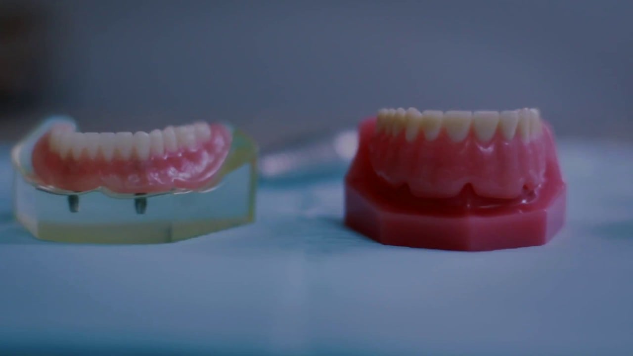 Wisdom Teeth and Implants Video Thumbnail